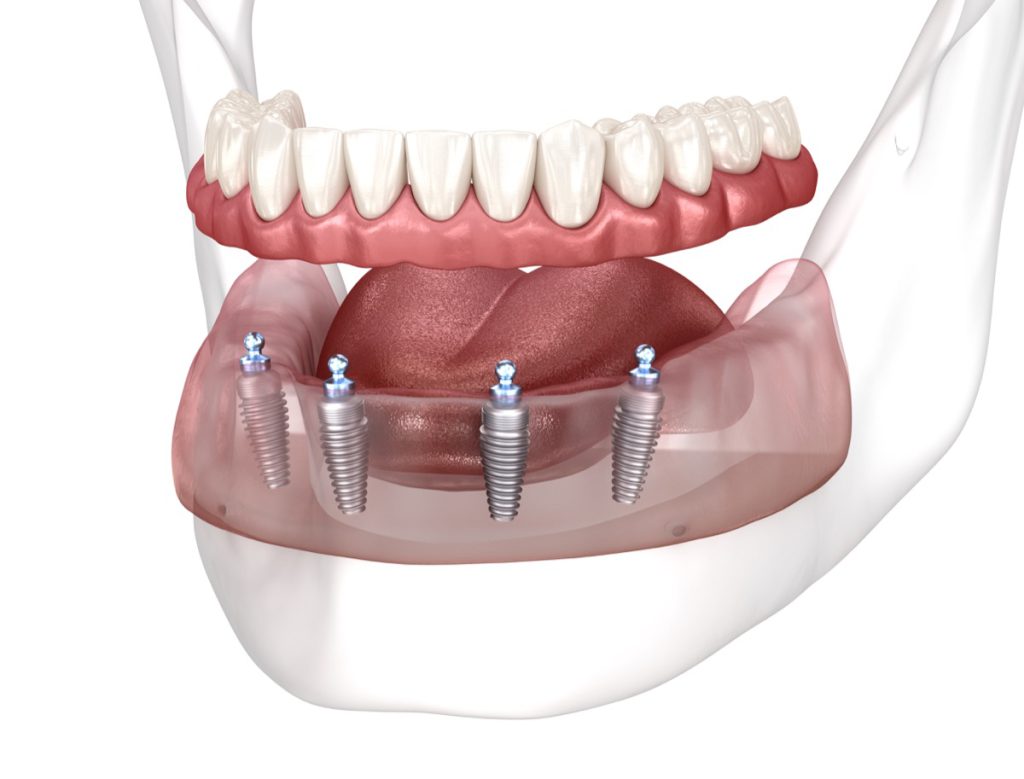 Removable mandibular prosthesis All on 4 system supported by implants. Medically accurate 3D illustration of human teeth and dentures concept