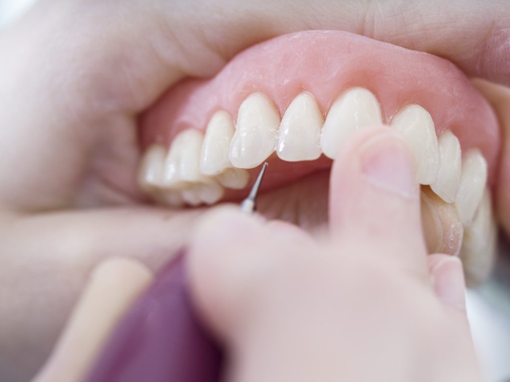 Dental technician is working with porcelain teeth in a cast molde in dental laboratory.